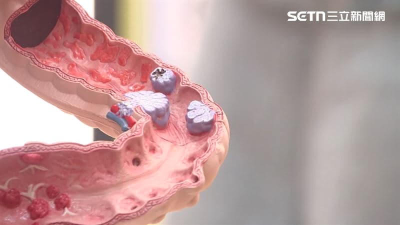 台大名醫自爆愛吃紅肉!靠「這3招」防大腸癌 警告千萬別碰1飲品(新聞配圖)