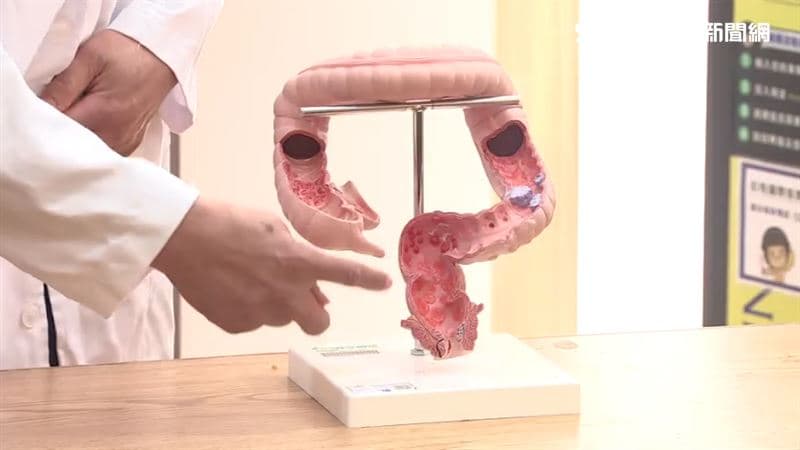 首次照大腸鏡揪出癌!50歲男排便都正常 驚見肝長滿腫瘤(新聞配圖)
