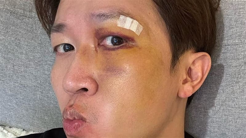 張立東重摔超慘!嚴重傷勢照片曝光 半張臉全瘀青腫成大豬頭(新聞配圖)