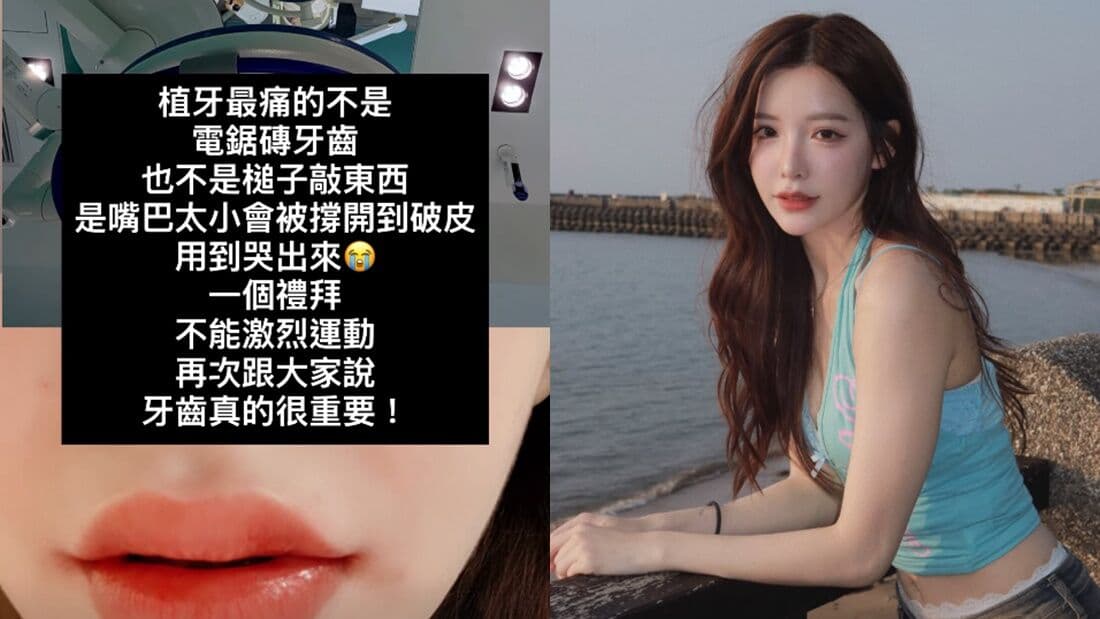 啦啦隊李恩菲「植牙痛到哭」 嘴巴被撐到破皮:牙齒真的很重要(新聞配圖)