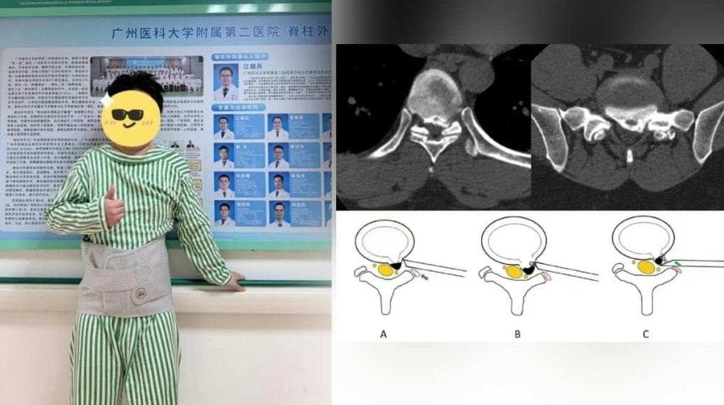 陸男睡覺「枕頭墊腰下」 翌日醒來竟下身癱瘓(新聞配圖)